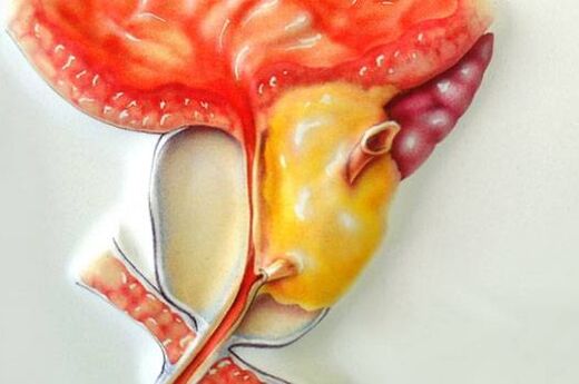 Простата обыры - бактериялық простатиттің озық сатысының салдары
